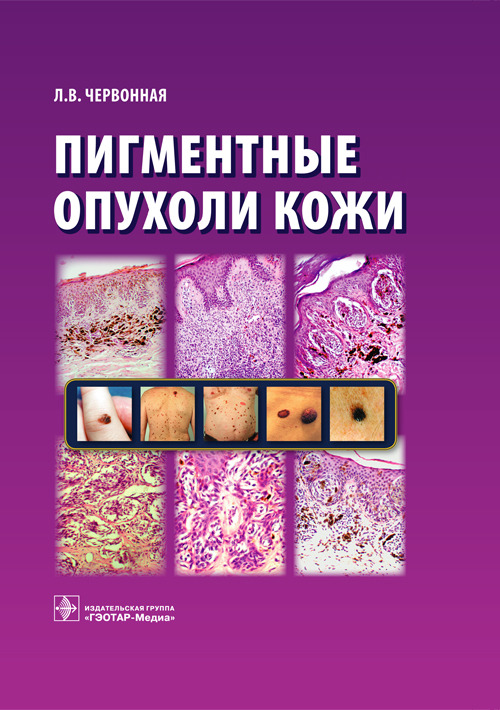 Пигментные опухоли кожи