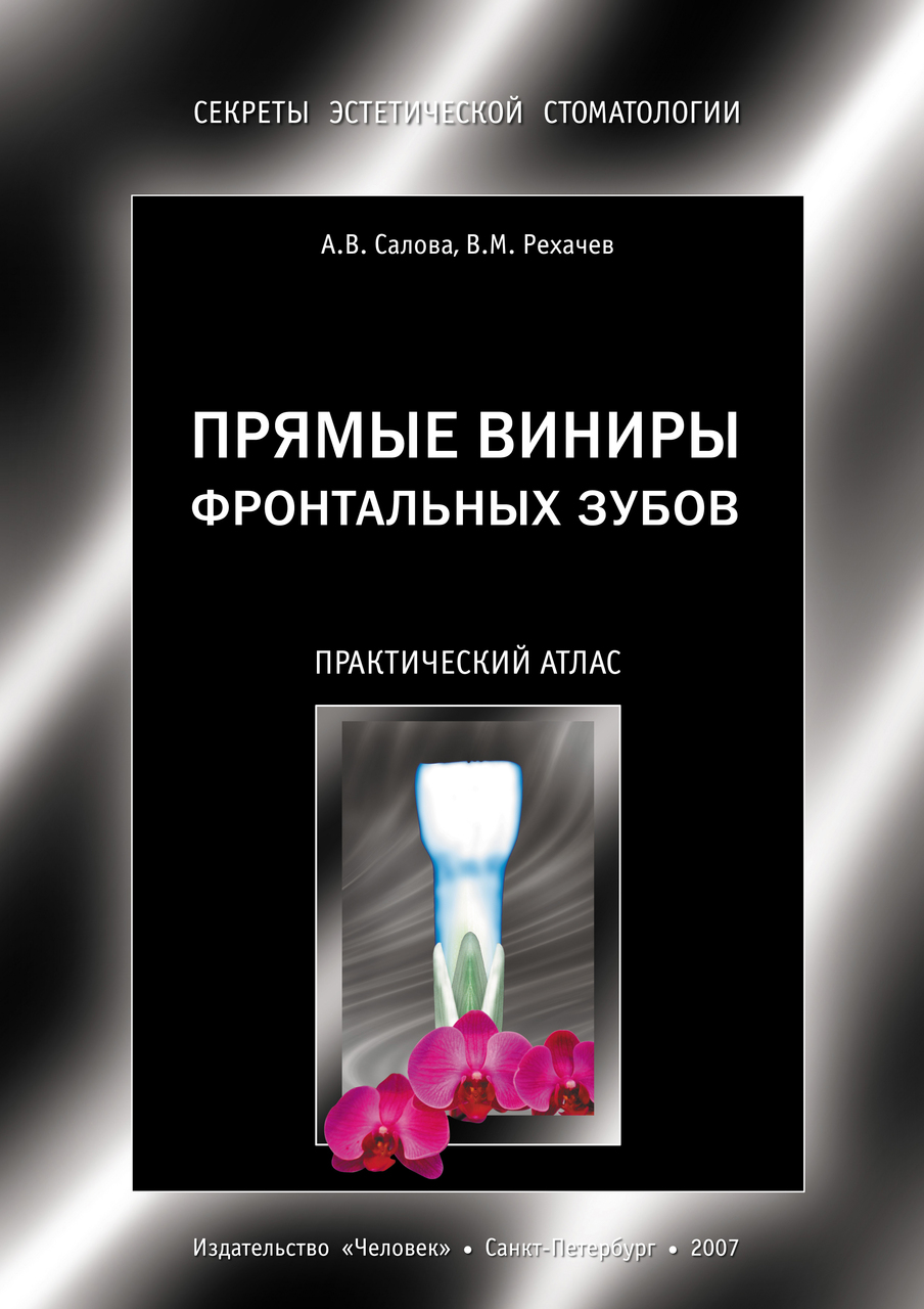 Прямые виниры фронтальных зубов